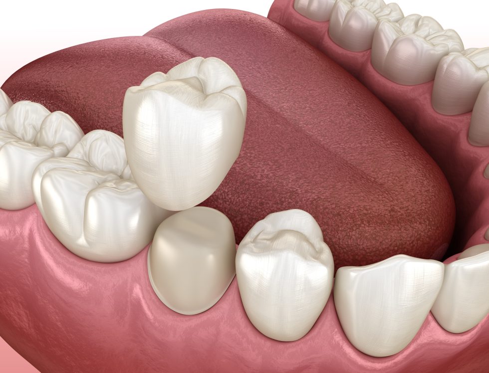 Week Teeth's Dental Crowns in Livonia, MI: Protect Weak Teeth