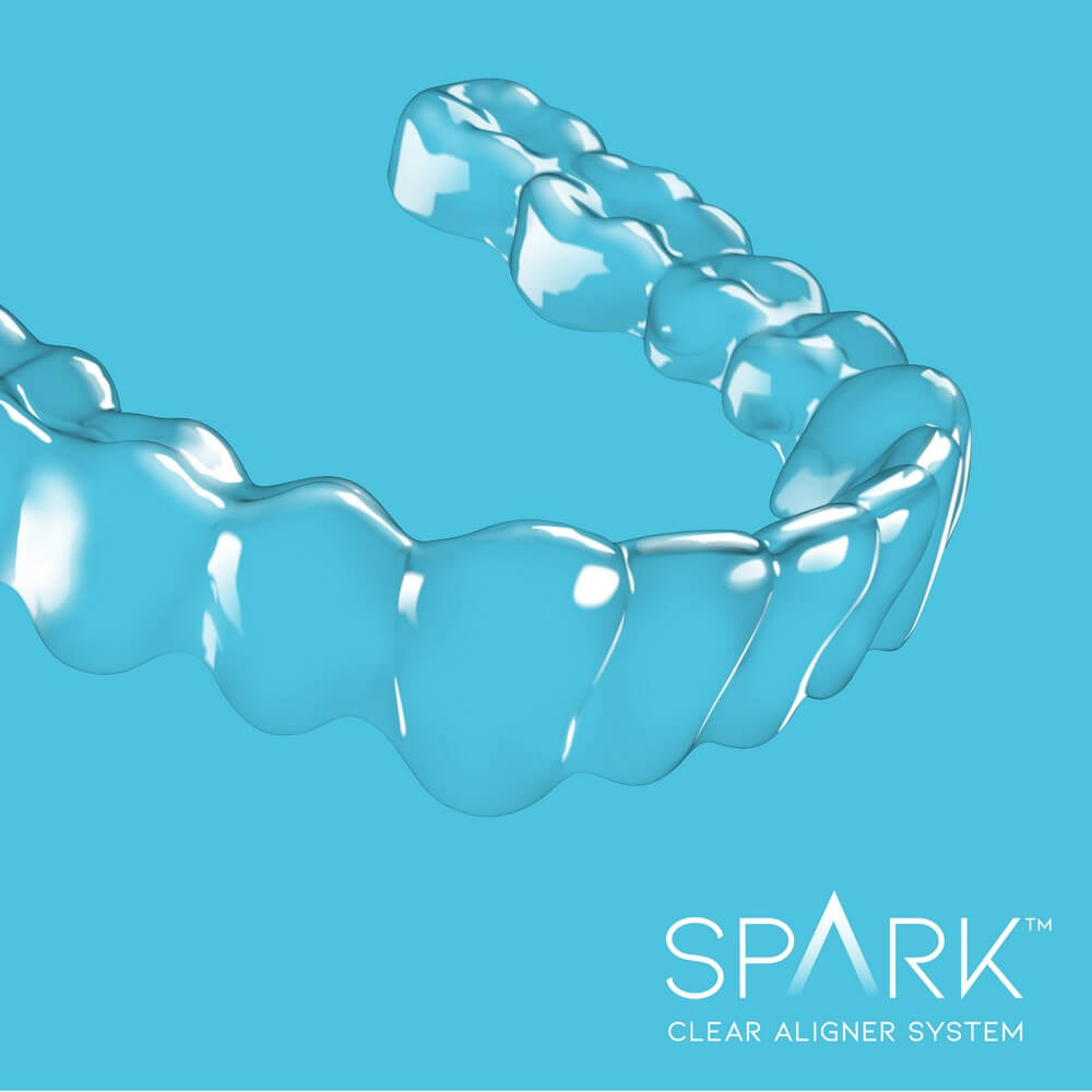spark aligners